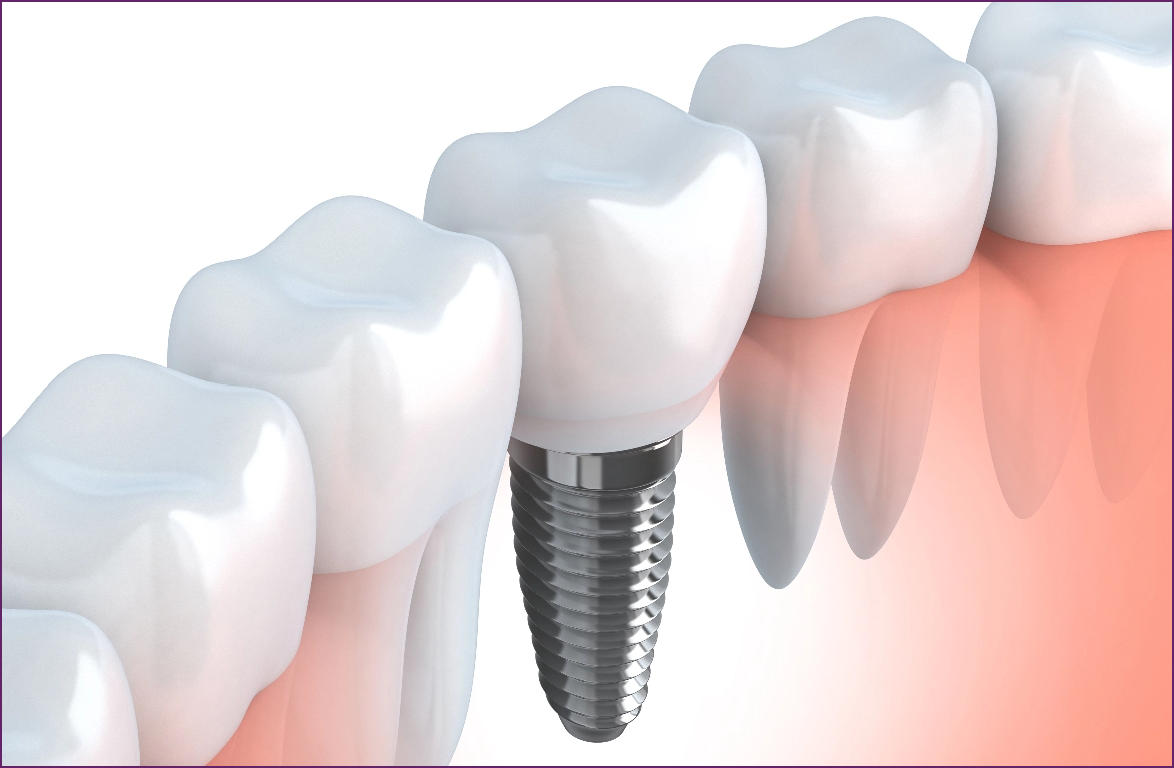 how-dental-implants-work