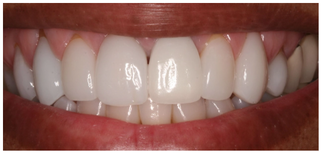 implant-after-01