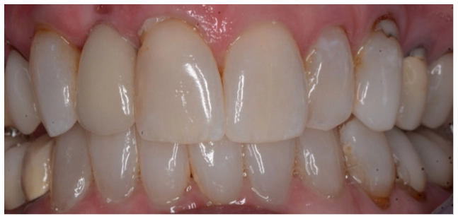 implant-after-02