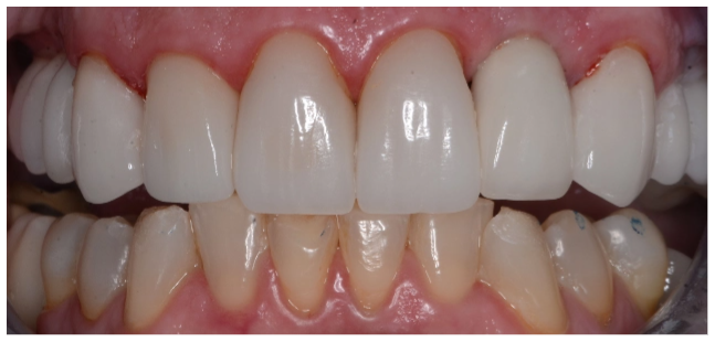 implant-after-03
