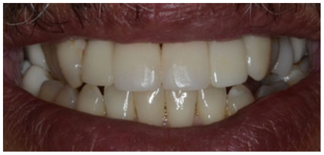 implant-after-05