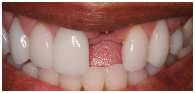 implant-before-01