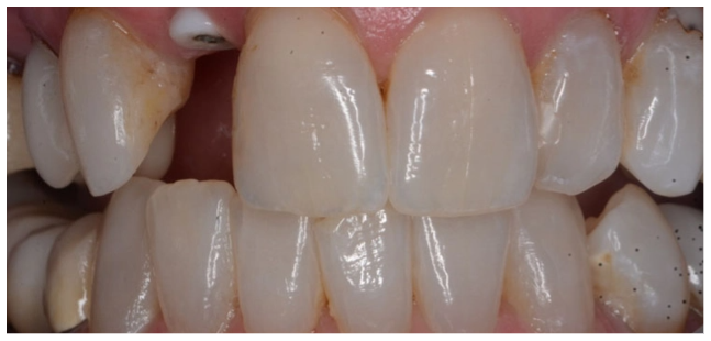 implant-before-02