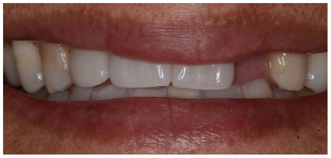 implant-before-04